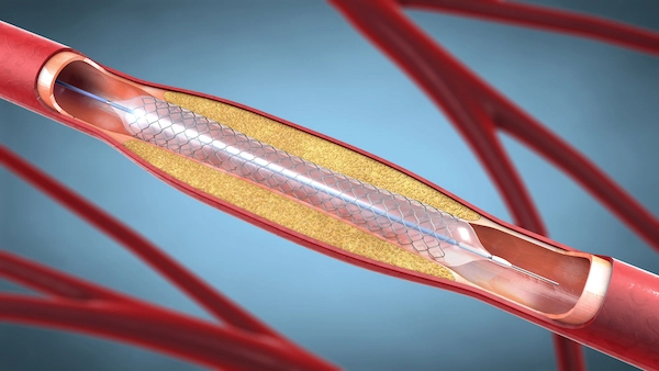 A closeup of coatings of stents and balloons